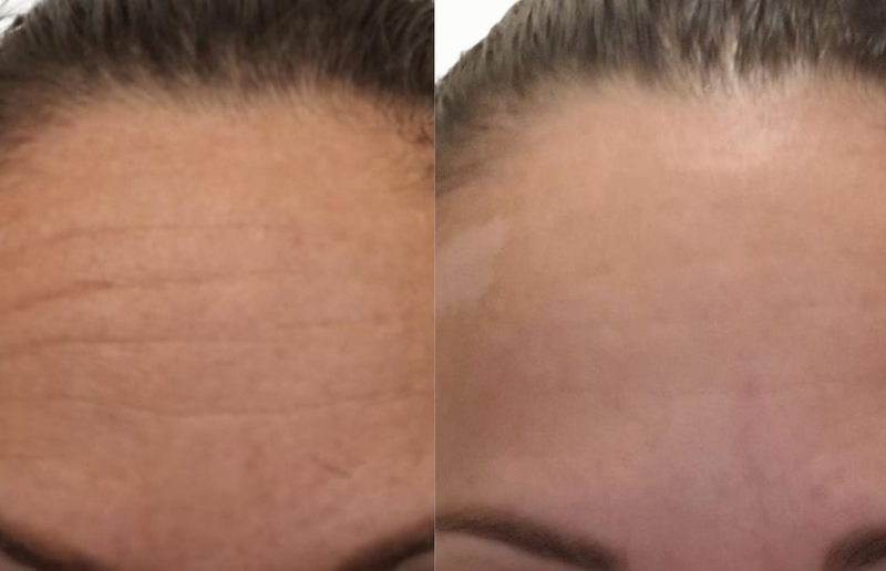 Lissage du front