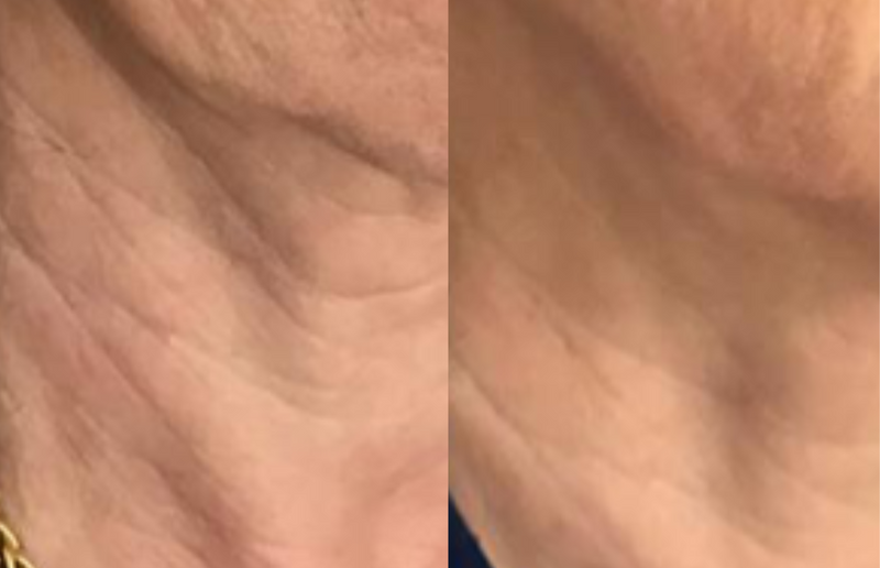 Cou & décolleté raffermis