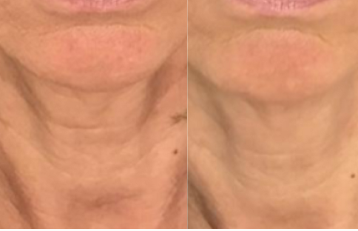 Rajeunissement global du bas du visage - Avant