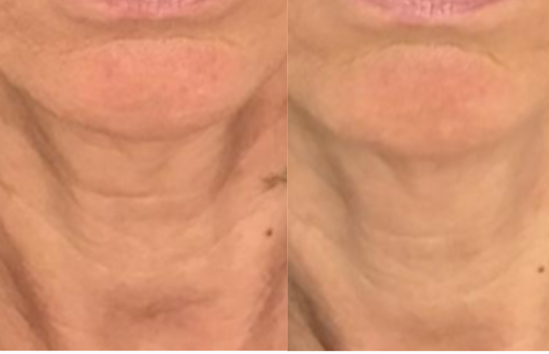 Rajeunissement global du bas du visage