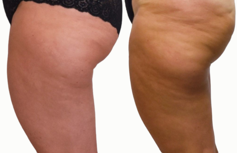 Côté de la cuisse