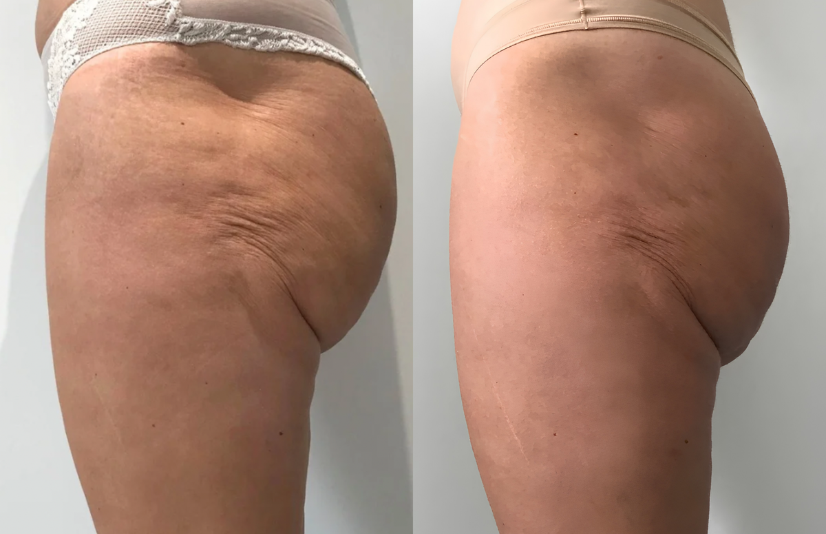Side of the thigh - Before